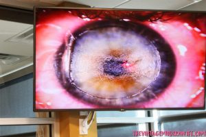 Considering getting LASIK done? Check out how BladeFree HD IntraLASIK changed this woman's life. She documented from the pre-op to the post op!